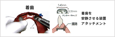 着歯を安静させる装置アタッチメント