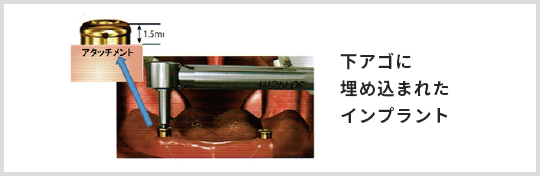下アゴに埋め込まれたインプラント
